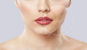 facial sunshine coast - skin treatment - skin clinic - acne treatment - facial therapy